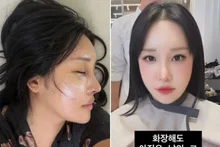 Lalal, Surprised by Her Drastically Changed Face After Surgery... 
