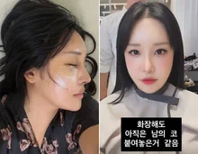 Lalal, Surprised by Her Drastically Changed Face After Surgery... 